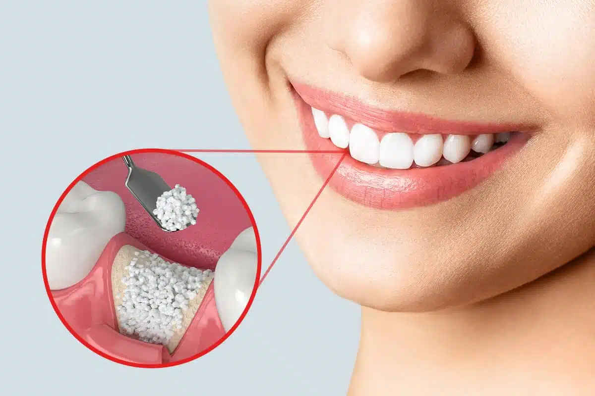 Bone Grafting in California, MD