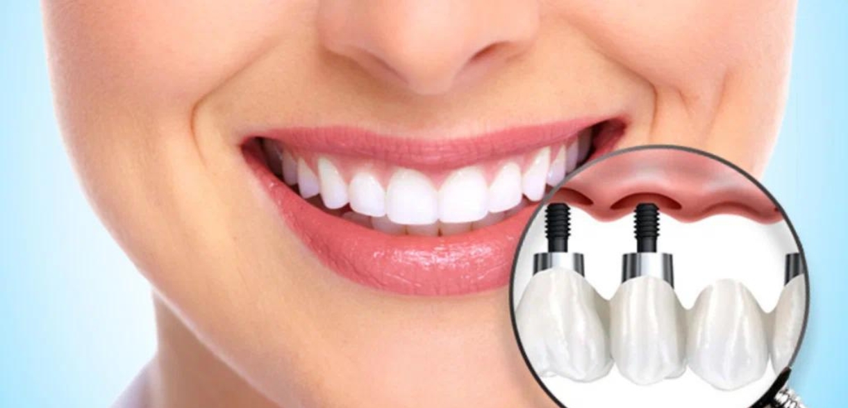 Dental Implants