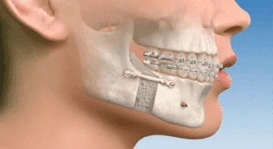 Corrective Jaw Surgery in California, MD