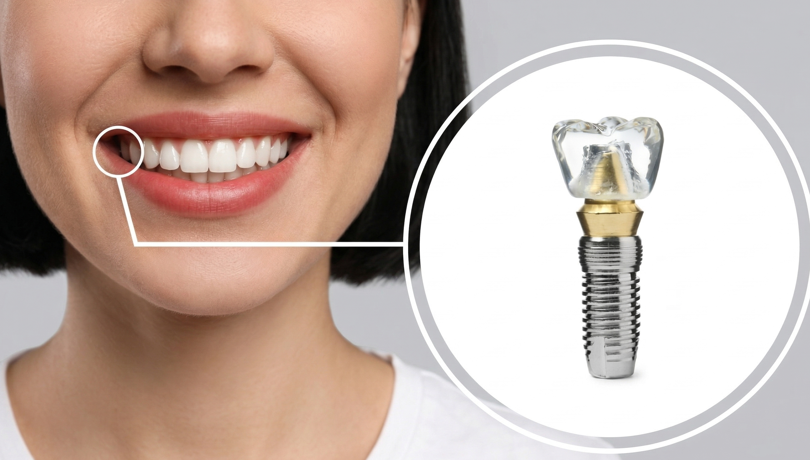 Dental Implants in California, MD